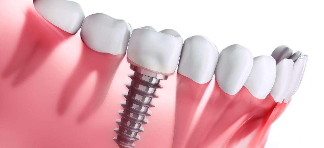 Your Dental Implant Journey What To Expect From Start To Finish